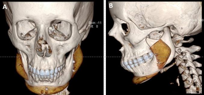 Dent Med Probl. 2018;55(4):367 370 369 Fig. 1. Three-dimensional cone beam computed tomogram showing a solid silicone implant placed at the mandibular angle A frontal view; B lateral view.