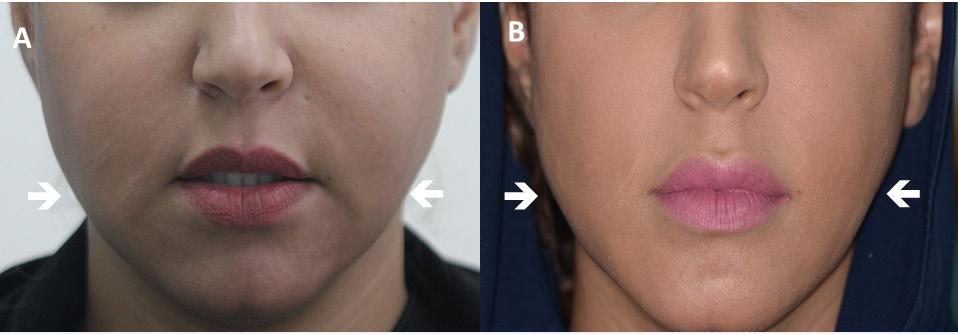 The patients were reviewed according to the following protocol: the 1 st follow up: 1 2 weeks; the 2 nd follow-up: 3 4 weeks; the 3 rd follow-up: 2 3 months; and the last follow-up: 6 months