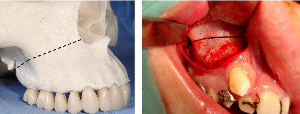 Dent Med Probl. 2018;55(4):371 378 373 Surgical interventions All surgical procedures were done under local anesthesia, 2% lidocaine with 1/80,000 epinephrine (Kwang Myung Pharm Co., Ltd.