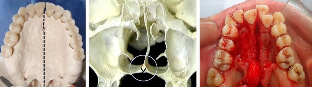 3) and modified a palatal osteotomy by adding a V-shaped midline osteotomy (Fig. 4) to ensure a complete mid-palatal suture separation and a full disjunction between the maxilla and the nasal septum.