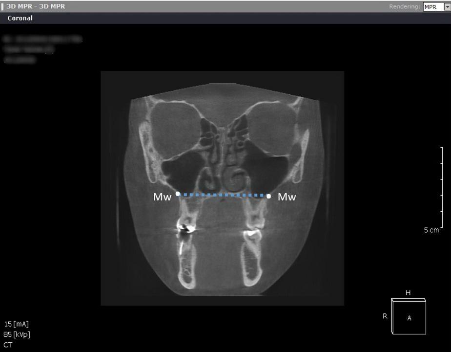 374 S. Yazigi, M. Zenati, R. Hadad. Effect of a new SAME technique on the upper airway we subtracted RPAV from TAV to obtain retroglossal airway volume (RGAV) (Fig. 10,11). Fig. 5.