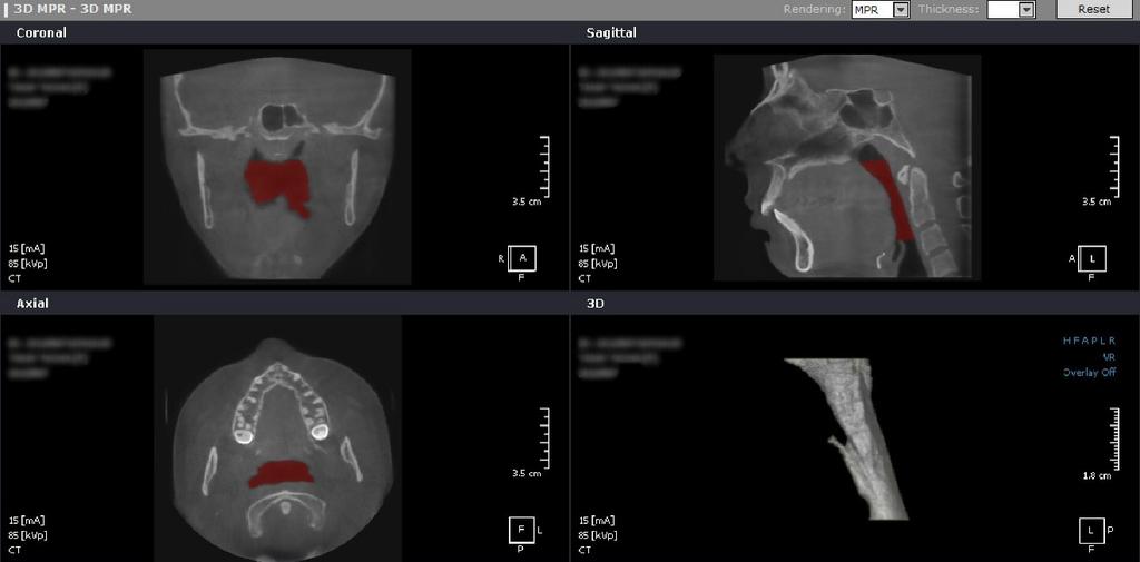 Total upper airway, retropalatal and retroglossal borders Fig. 7.