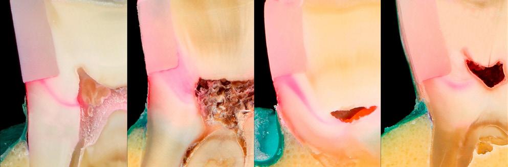methacrylate-based bulk-fill composite resin light cured, methacrylate-based bulk-fill composite resin light cured, methacrylate-based bulk-fill composite resin light cured, methacrylate-based