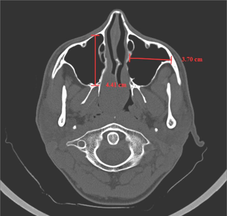 Dent Med Probl. 2018;55(4):411 417 413 Fig. 1. Axial computed tomography (CT) scan showing the measurement of the anteroposterior (AP) and mediolateral (ML) dimensions Fig. 3.