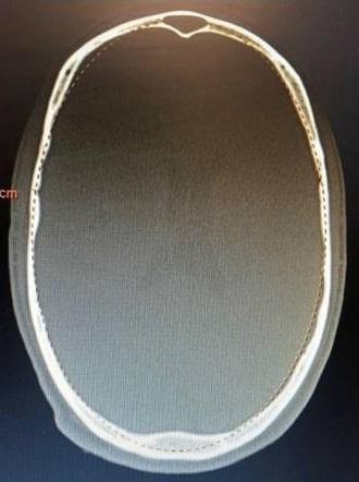 4). All these measurements were made with the help of a screen linear measurement tool on the CT workstation.