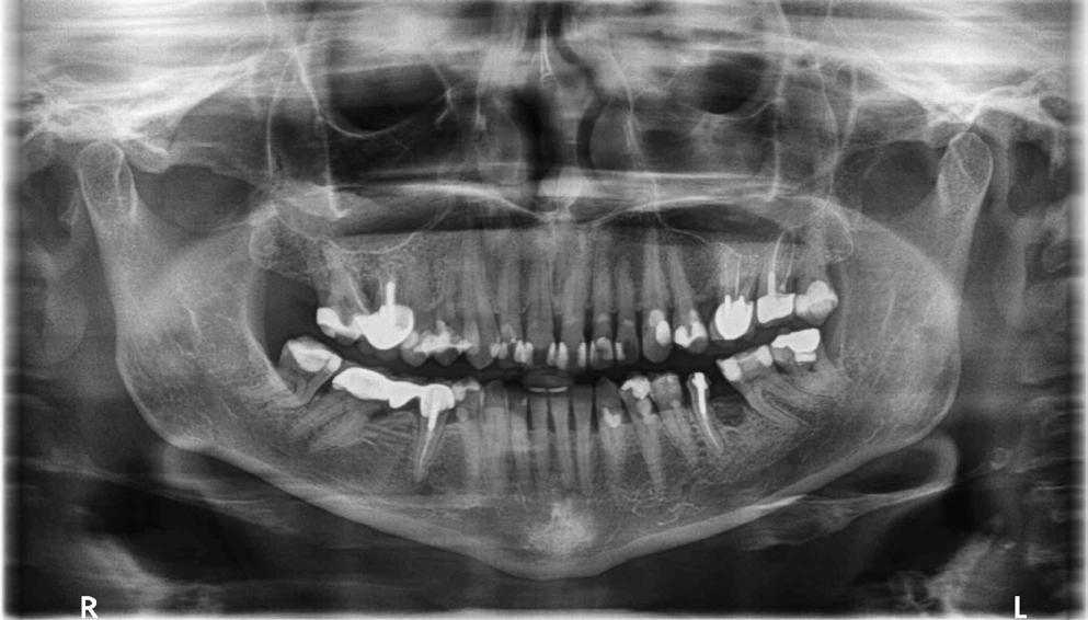 osteoporosis, Paget disease, and osteogenesis imperfecta. 1,2 They belong to a group of inorganic pyrophosphatic derivatives and are a compound of 2 phosphonate groups connected by esterification.
