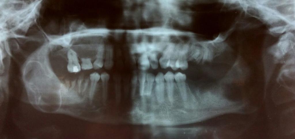 Multiple non-syndromic odontogenic keratocyst Introduction Odontogenic keratocyst (OKC) is a distinctive form of developmental odontogenic cyst that deserves special consideration owing to its