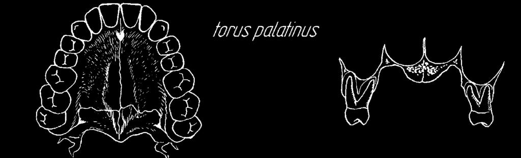 20.c torus palatinus wał kostny, bądź