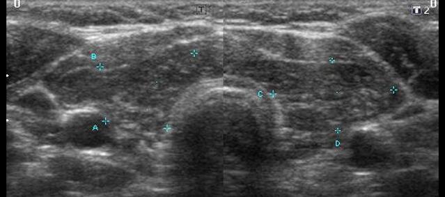 W badaniu USG tarczycy: Echogenność obu płatów niejednorodna, obniżona.