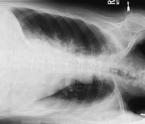 Klatka piersiowa pozycja leżąca na boku 1 Klatka piersiowa Kryteria oceny prawidłowego wykonania Uwidocznienie struktur anatomicznych Całe pola płucne, w tym szczyty płuc i kąty przeponowo-żebrowe.