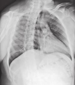 Klatka piersiowa pozycja przednio-skośna RAO i AO 1 Klatka piersiowa Kryteria oceny prawidłowego wykonania Uwidocznienie struktur anatomicznych Oba pola płucne od szczytów do kątów przeponowo-