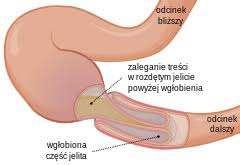 Wgłobienie u dziecka, (którego szczyt występowania przypada w