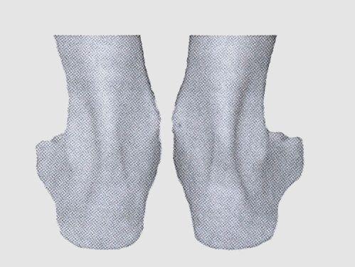 Wady stóp: stopa płaska - obniżenie podłużnego