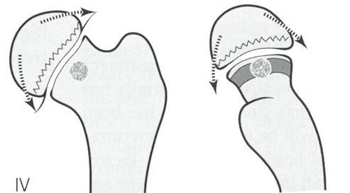 podchrzęsne 3/4