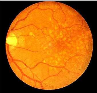 Guidelines for clinical multifocal electroretinography