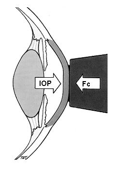 Tonometria (badanie ciśnienia śródgałkowego) Tonometr Goldmanna Równowaga sił: F + F = IOP A + F c np szt Fc siła odkształcająca Fnp siła napięcia powierzchniowego IOP ciśnienie śródgałkowe Fszt siła