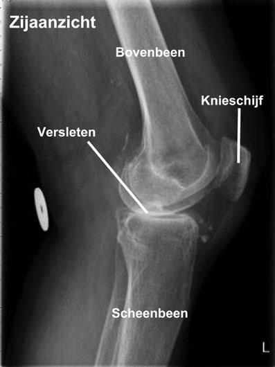 Er kan een hemi-knieprothese overwogen worden, als fysiotherapie, medicijnen en het aanpassen van uw levensstijl onvoldoende helpen.