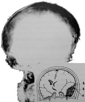 Ryc. 4. Mechanizm powstawania krwiaka nadtwardówkowego [ 40 ]: 1) Krwiak uciskający i przemieszczający płat skroniowy. 2) Przerwana tętnica oponowa środkowa.