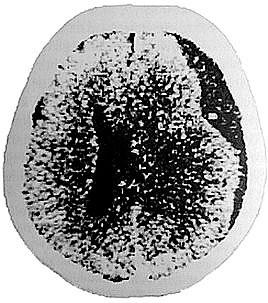 Ryc. 6. Przewlekły krwiak podtwardówkowy nad prawą półkulą mózgu. Ucisk i przemieszczenie półkuli prawej komory bocznej mózgu (TK) [ 49 ].
