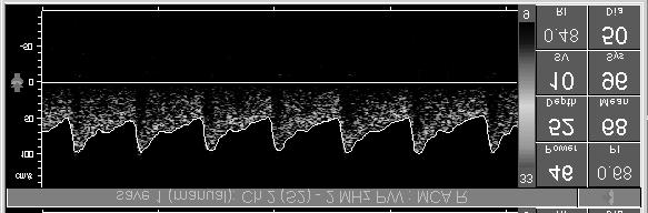 Rycina1 Parametry przep³ywu krwi w MCA u dziewczynki z omdleniami neurokardiogennymi przed rozpoczêciem pionizacji mierzone za pomoc¹ ultrasonografii dopplerowskiej (=96 cm/s, =50 cm/s, =68 cm/s).
