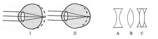 Zadanie 7. (2 pkt) Na schematach przedstawiono schemat gałek ocznych z wadą wzorku u człowieka oraz różne rodzaje soczewek.