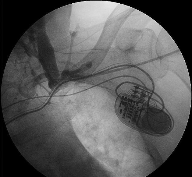 Introduction Significant symptoms of venous occlusion or thrombosis in patients with a pacemaker or implantable cardioverter-defibrillator (ICD) are rarely observed in clinical practice.