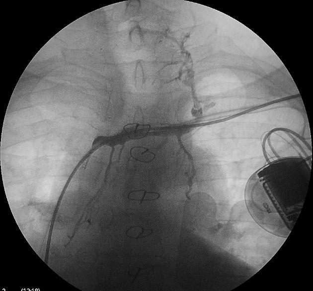 in 10-25% of patients and clinical symptoms are present in 1-3% of cases [1, 2].