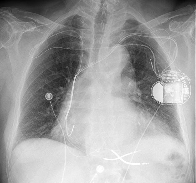 Electrodes were dissected by means of an electric knife and their lumen was engaged with a standard guidewire.