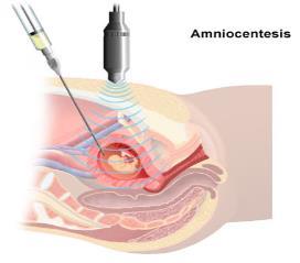 przedimlantacyjna (PGD), - amniopunkcja