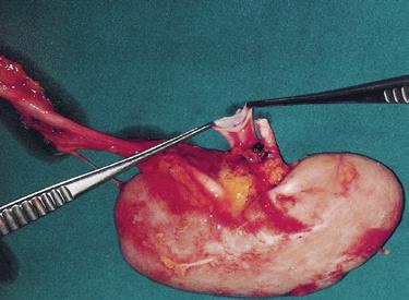 Przeszczepienie nerki Nie zawsze własne, niewydolne nerki muszą być usunięte przed przeszczepieniem. Etapy procedury: A. Pobranie nerki B.