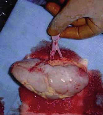 Przeszczepienie nerki Przeszczepienie narządów jest zaawansowaną technicznie i technologicznie operacją.