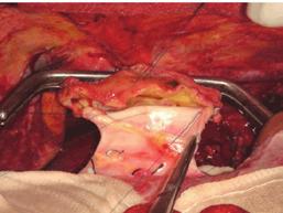 Wszczepienie nowej wątroby w miejsce starej (ortotopowo) Operację rozpoczyna się usunięciem