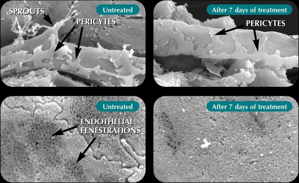 Normalizacja patologicznego unaczynienia po zahamowaniu VEGF 1 * Zaadaptowano z Inai 2004. 1 Przedruk z Am J Pathol 2004, 165:35-52 za zgodą American Society for Investigative Pathology.