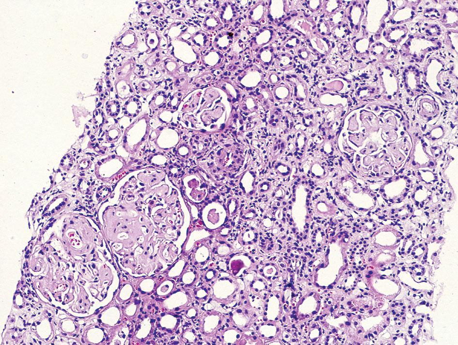 ZMIANY W NERKACH W TOCZNIU RUMIENIOWATYM UKŁADOWYM I INNYCH CHOROBACH AUTOIMMUNOLOGICZNYCH Tabela VI.