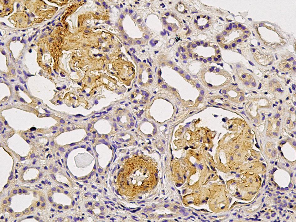 Barwienie immunohistochemiczne z przeciwciałem przeciwko amyloidowi AA Rycina