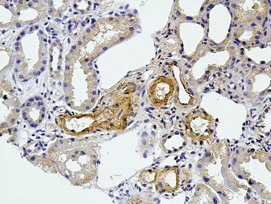 ZMIANY W NERKACH W TOCZNIU RUMIENIOWATYM UKŁADOWYM I INNYCH CHOROBACH AUTOIMMUNOLOGICZNYCH Glomerulopatie polekowe mają podłoże immunologiczne i występują nie wcześniej niż po upływie 3 miesięcy