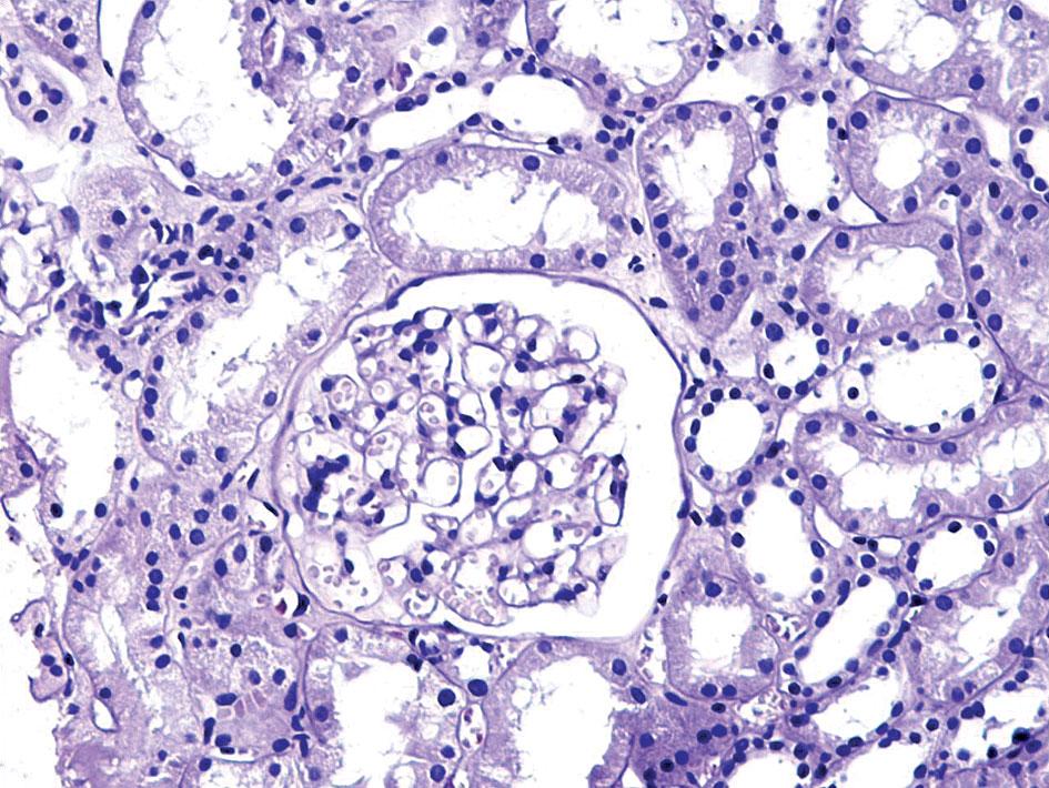 ZMIANY W NERKACH W TOCZNIU RUMIENIOWATYM UKŁADOWYM I INNYCH CHOROBACH AUTOIMMUNOLOGICZNYCH Tabela II. Klasyfikacja nefropatii toczniowej wg WHO (po modyfikacji w 1982 r.