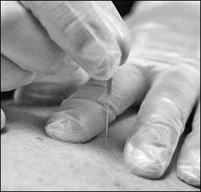 Dry needling sucha igłoterapia Metoda terapii polegająca na umieszczaniu igły akupunkturowej w punkcie