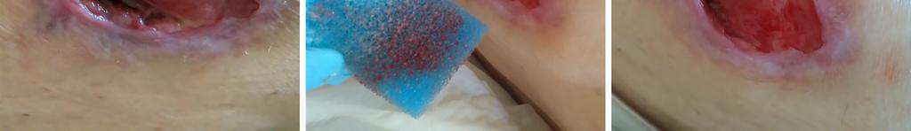 debridement