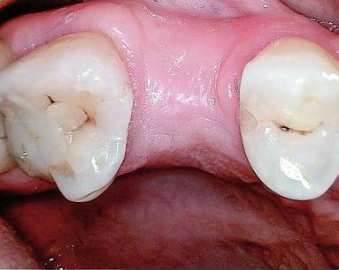 zębami wynosiła 10 mm (ryc. 4). Wnikliwa diagnostyka pozwoliła na zakwalifikowanie pacjentki do zabiegu implantacji natychmiastowej z jednoczesnym podniesieniem dna zatoki szczękowej.