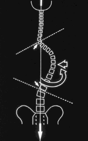 korekcyjnym oddziaływać na poziomie skrzywienia poprzez ustabilizowanie, rozciągnięcie i derotację kręgosłupa. (Ryc.2).