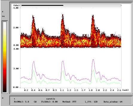 Metoda ultradźwiękowa z emisją ciągłą CW (Continuous Wave) Podstawowe parametry sygnału dopplerowskiego prędkości przepływu krwi
