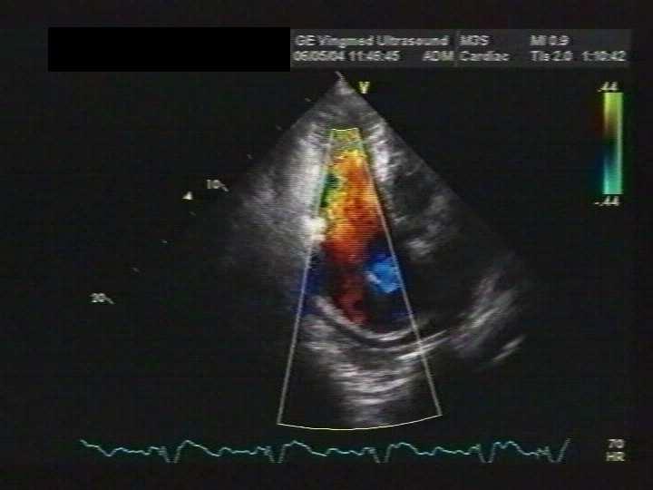 Różne typy obrazowania 2D, kolorowa mapa prędkości (CFM) i sonogram Kolorowa mapa prędkości wynik pomiaru prędkości przepływu krwi w w poszczególnych punktach obszaru