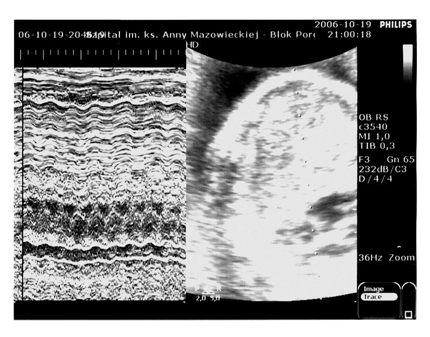 czynniki zewnętrzne (oksytocyna) Detekcja ruchów płodu i rytmu serca płodu (kardiotokografia) ultrasonogram M