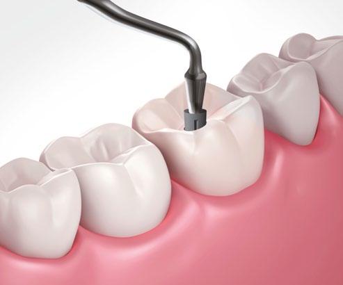 prewencja periimplantitis oraz periimplant mucositis W 80% przypadków zdrowych implantów występuje zapalenie dziąsła.