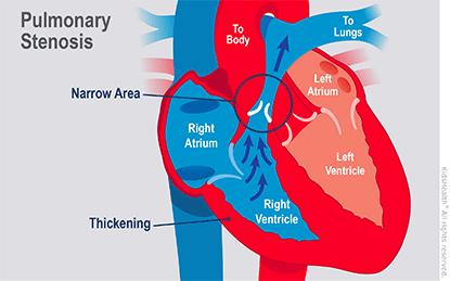 tętnicze - zwężenie tętnic nerkowych