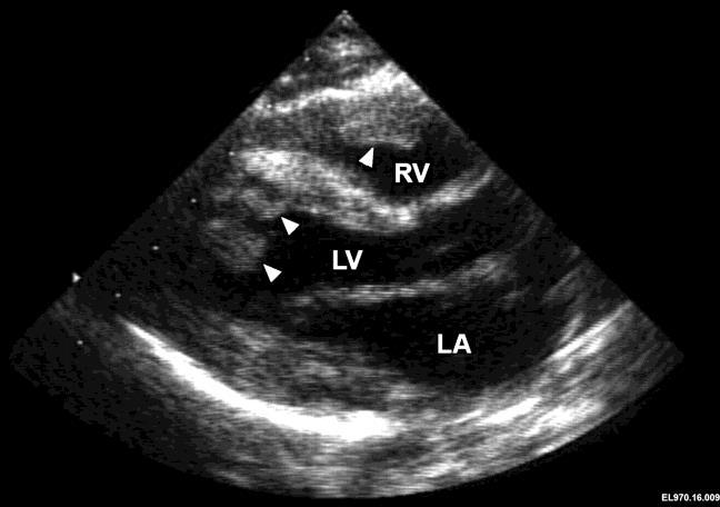 Stwardnienie guzowate Objawy kardiologiczne: Guzy rhabdomyoma serca (50% pacjentów, <2rż 90% pacjentów) najwcześniej