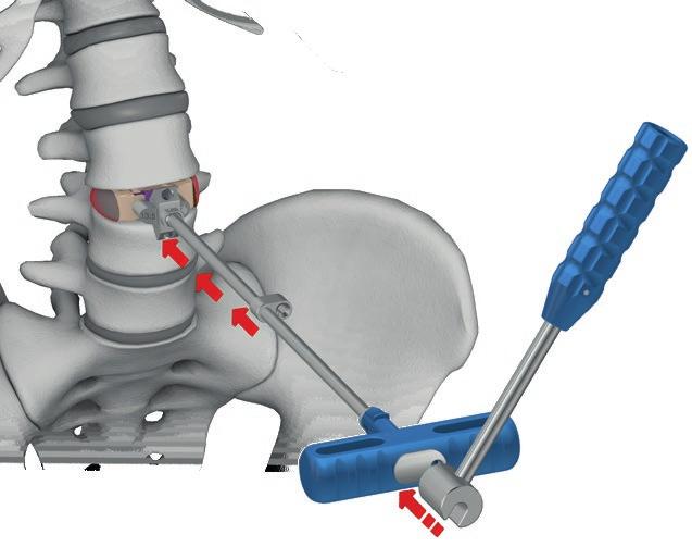 TECHNIKA OPERACYJNA IV.6. WPROWADZENIE IMPLANTU W celu ułatwienia wprowadzenia implantu można posłużyć się szczypcami dystrakcyjnymi.
