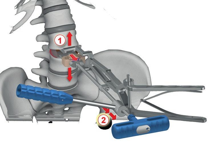 implantu; usunąć wkręty przy pomocy wkrętaka T15 [40.5822.000] (złożonego z Kluczem dynamometrycznym [40.5270.280]); po usunięciu wkrętów złożyć manipulator [40.5824.000] z chwytakiem [40.