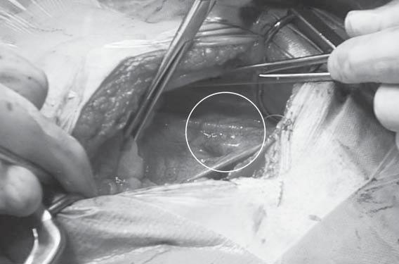Sentinel node identification in cervical cancer patients: 5 years experiences 53 to a histopathological evaluation, followed by pelvic and/ or periaortal nodes.